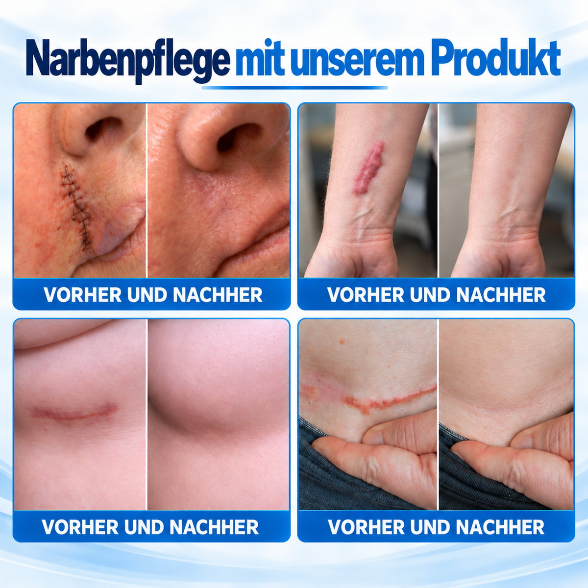Dr.Fachmer® 🏆 Bio-Regeneratives Mikronadel-Narbenpflaster – Reparaturprotein-Silikonpflege für Kaiserschnitt- & postoperative Narben