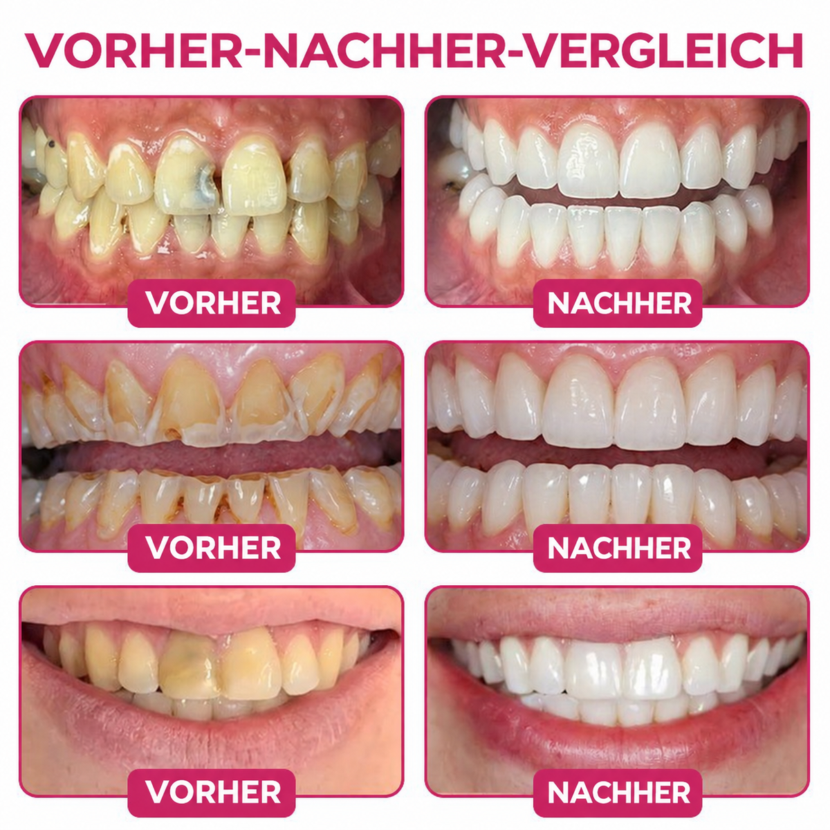 🤍 Rolimey® DenPerm – Natürliches Zahnschmelz-Füllgel zur Kariessanierung
