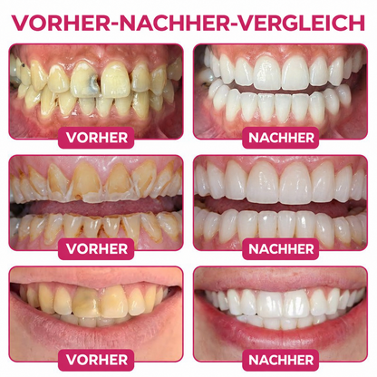 🤍 Rolimey® DenPerm – Natürliches Zahnschmelz-Füllgel zur Kariessanierung