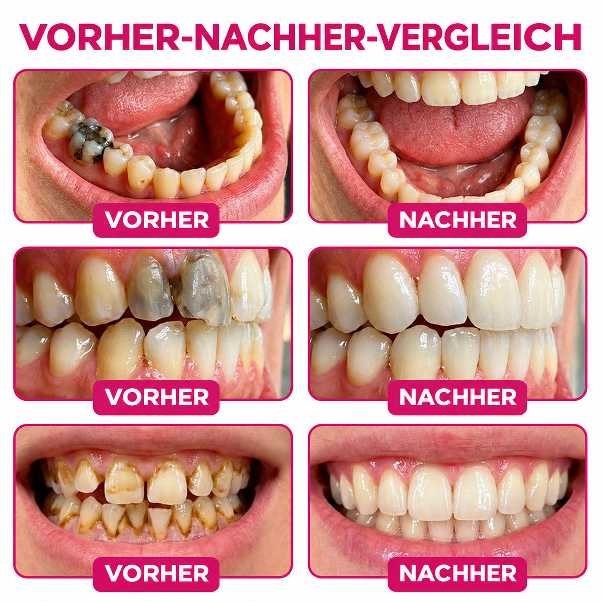 🤍 Rolimey® DenPerm – Natürliches Zahnschmelz-Füllgel zur Kariessanierung